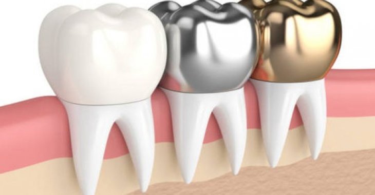 Dental Crowns