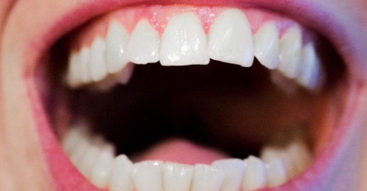 The truth about Teeth Whitening