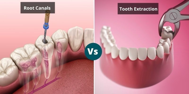 Root Canal Versus Tooth Extraction - Which is better?