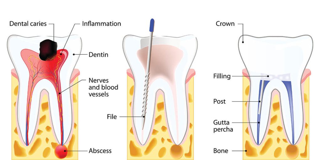 Why is root canal treatment better than extraction?