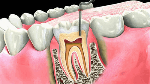 Misconceptions about Root Canal Treatment