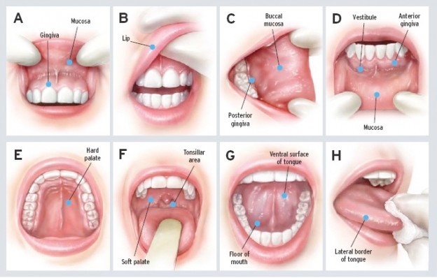 Common signs of Oral Cancer