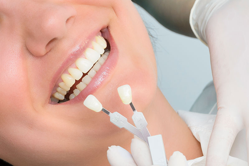 What are Dental Veneers?