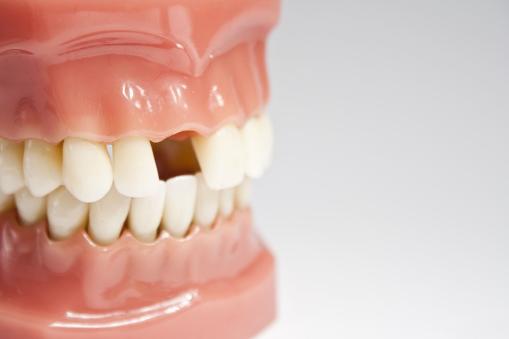 Tips to keep your front teeth this Christmas