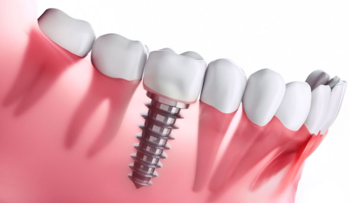 dental-implants