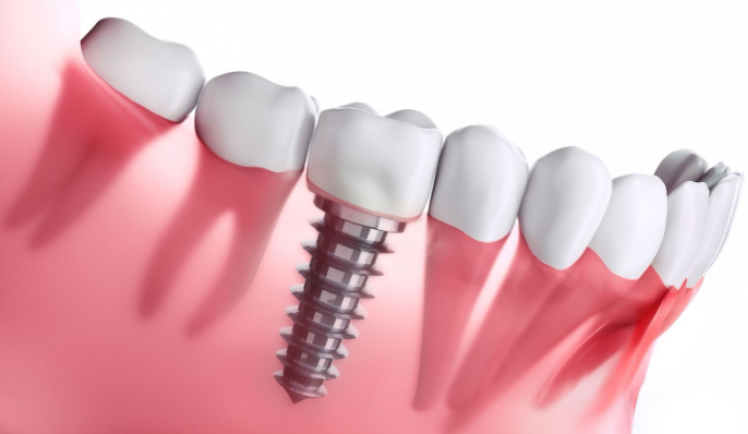 How do Dental Implants work?