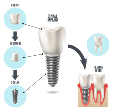 How are Dental Implants fitted?