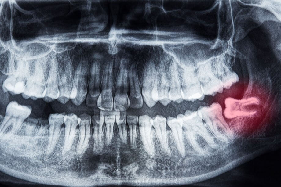 Wisdom tooth Panorex Xray