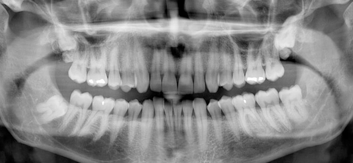 Panoramic Xray - Dental Xray