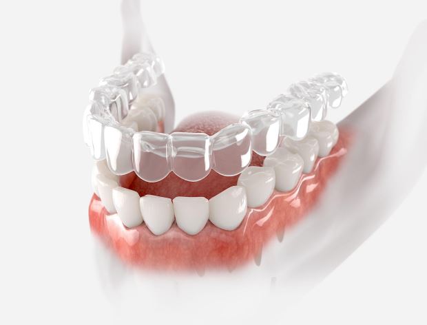 What is Invisalign?