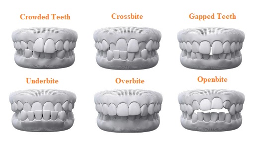 Invisalign treatment for orthodontic issues