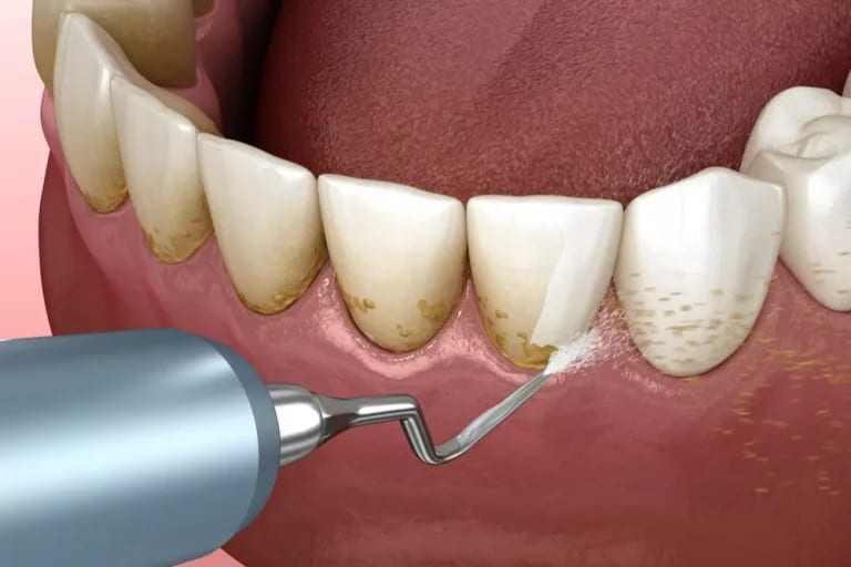 Why is Dental Deep Cleaning Necessary?