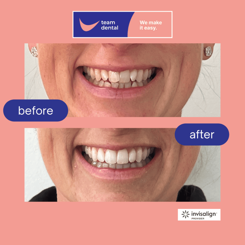 Invisalign Clear Aligners - Before and After