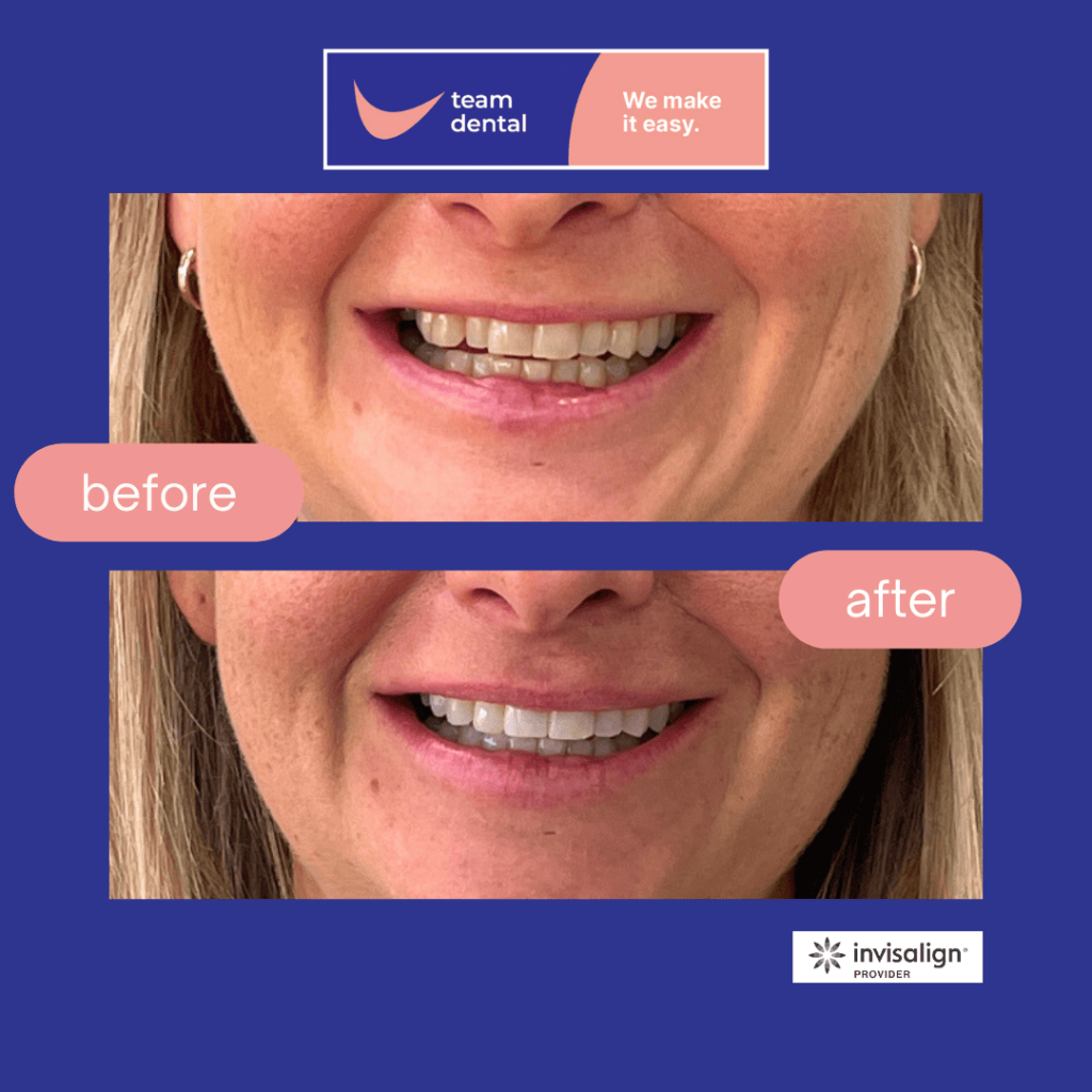 Before and After - Invisalign Clear Aligners